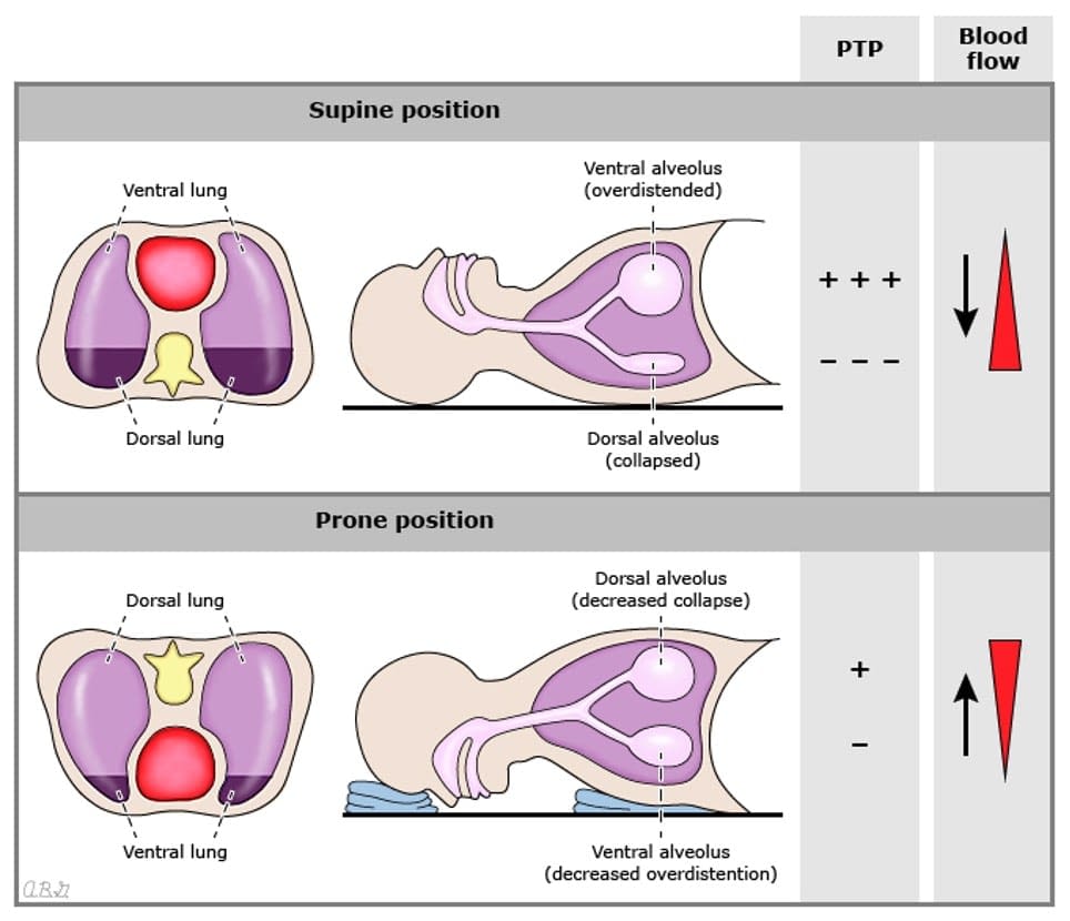Prone positioning for awake, nonintubated patients with SARSCOV2
